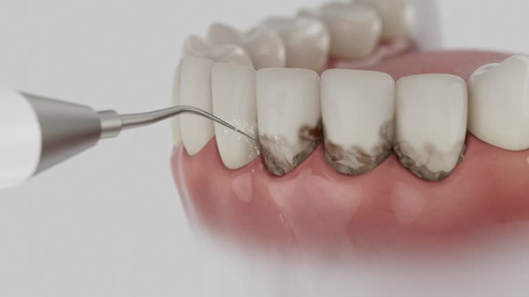 Reliable Tooth Extraction contractor in USA by Smile Center Dentistry